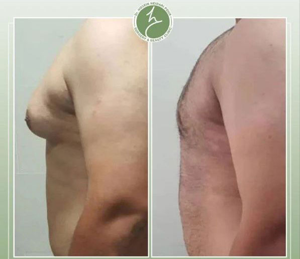 بزرگی سینه در آقایان؛ علت ژنیکوماستی چیست؟