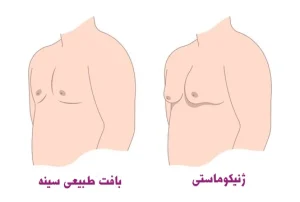 علت ژنیکوماستی در مردان
