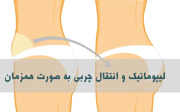 لیپوماتیک و تزریق چربی