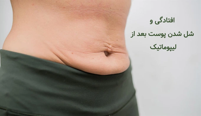 افتادگی و شل ششدن پوست بعد از لیپوماتیک