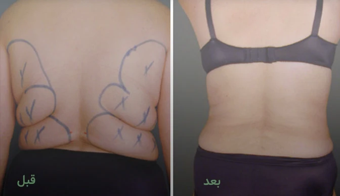 لیپوماتیک و لیفت کمر