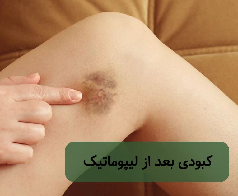 ورم و کبودی بعد از لیپوماتیک