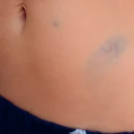 کبودی و ورم بعد از لیپوماتیک