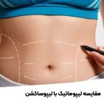 مقایسه لیپوماتیک با لیپوساکشن