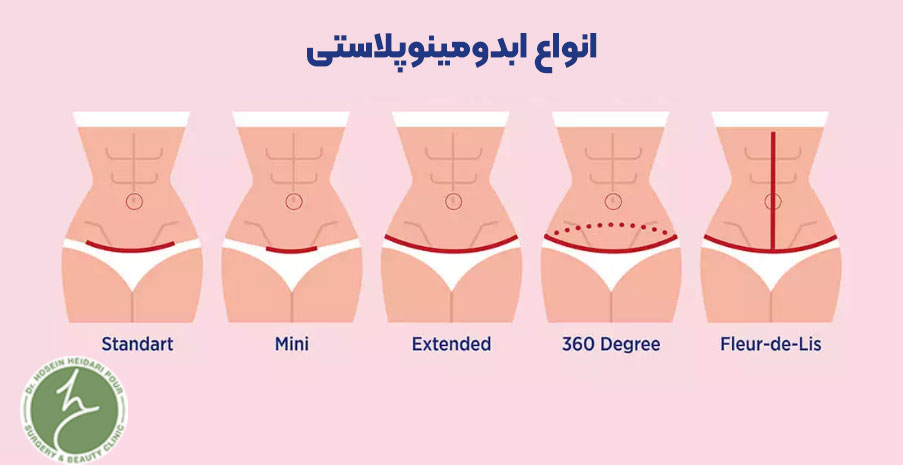 انواع ابدومینوپلاستی