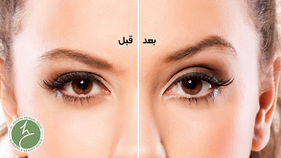 لیفت ابرو با بوتاکس