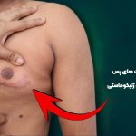 مراقبت های پس از جراحی ژنیکوماستی