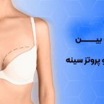 تفاوت بین ماموپلاستی و پروتز سینه