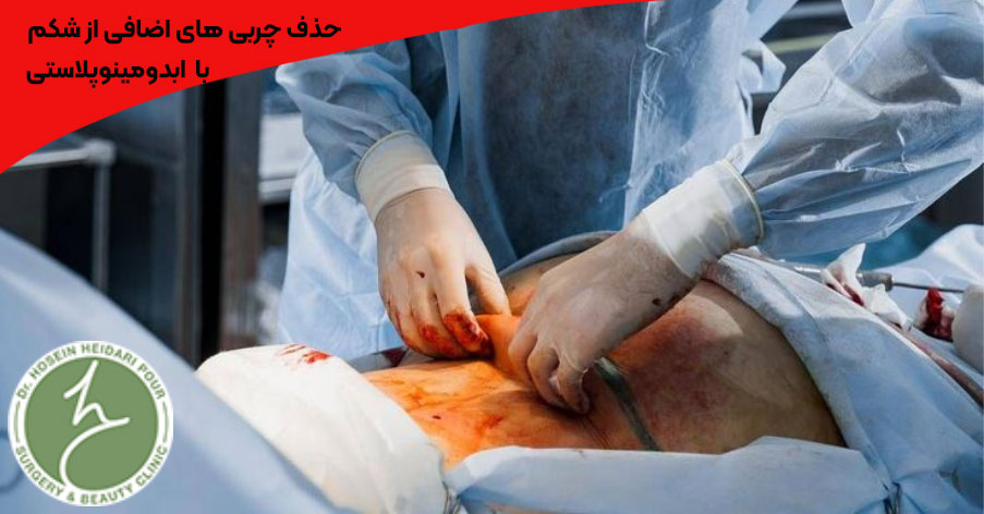 هزینه‌ های جراحی زیبایی شکم بسته به نوع جراحی