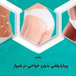 پیکرتراشی بدون جراحی در شیراز