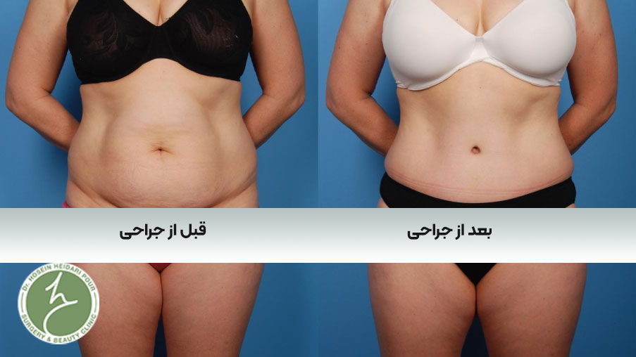 جراحی زیبایی شکم یا ابدومینوپلاستی