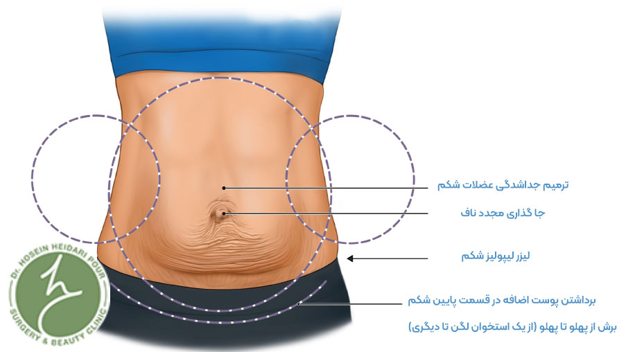 مراحل انجام ابدومینوپلاستی