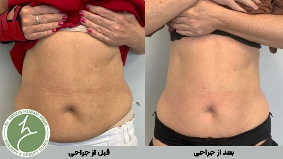 انتخاب روش مناسب جراحی پیکرتراشی