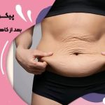 پیکرتراشی بعد از کاهش وزن شدید
