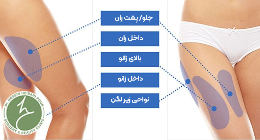نواحی هدف در لیپوماتیک ران