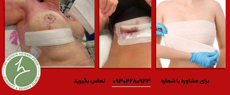 پانسمان ماموپلاستی