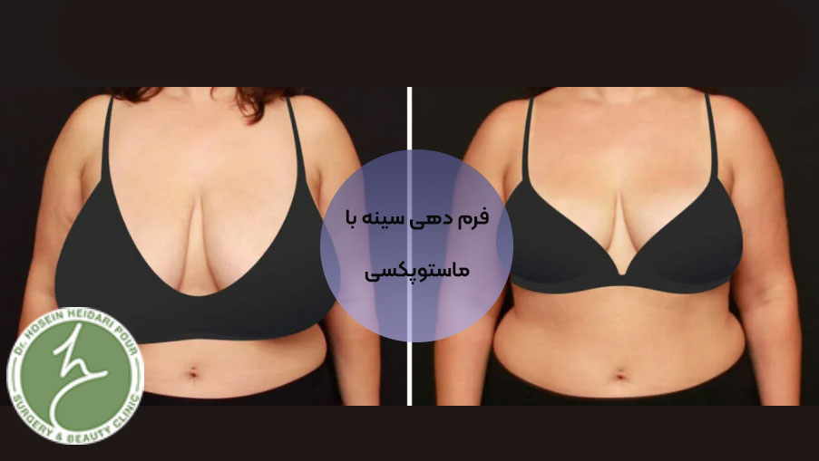 لیفت سینه یا ماستوپکسی