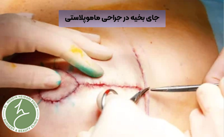 اسکار در جراحی ماموپلاستی 