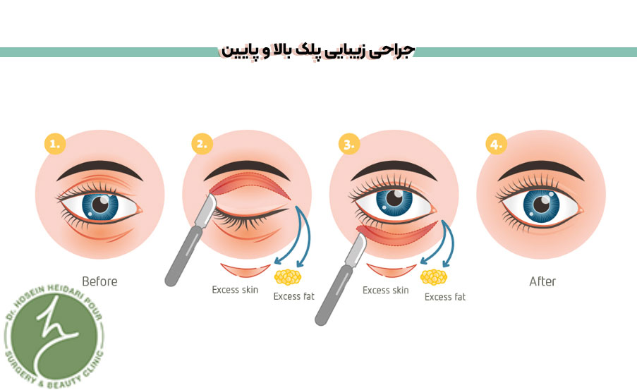 انواع بلفاروپلاستی