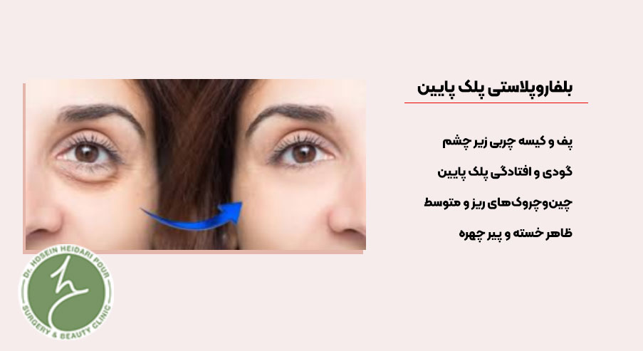 بلفاروپلاستی پلک پایین