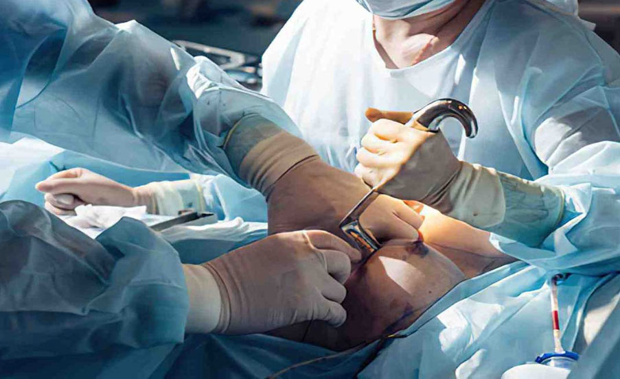 فرآیند جراحی ماموپلاستی