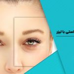 بلفاروپلاستی با لیزر
