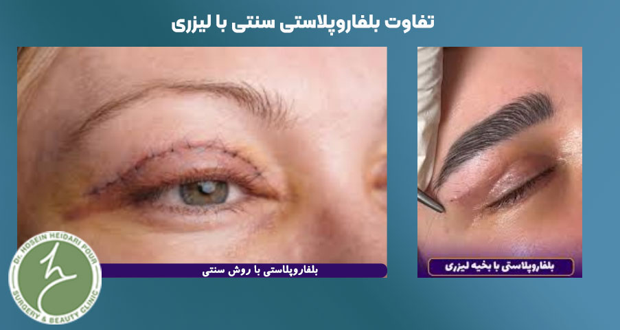 مزایای بلفاروپلاستی با بخیه لیزر