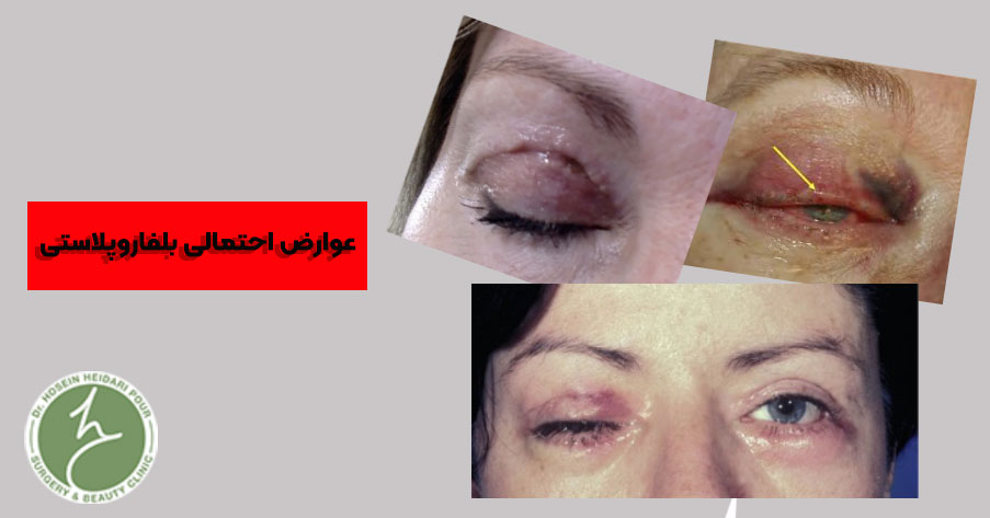 عوارض احتمالی بلفاروپلاستی