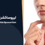 لیپوساکشن غبغب