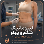 لیپوماتیک شکم و پهلو چگونه انجام میشود؟