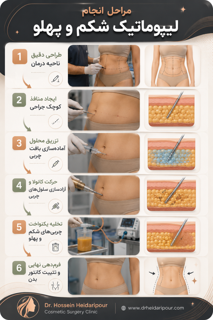 لیپوماتیک شکم و پهلو چگونه انجام میشود؟
