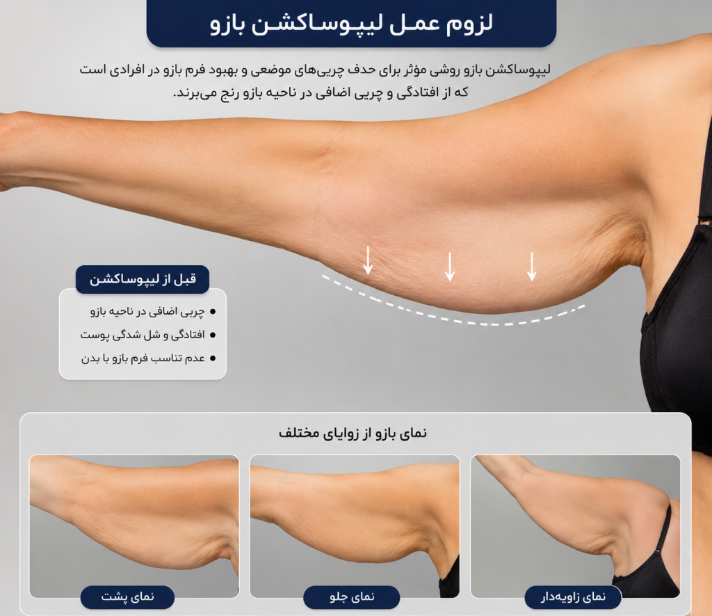 لیپوساکشن بازو چیست؟