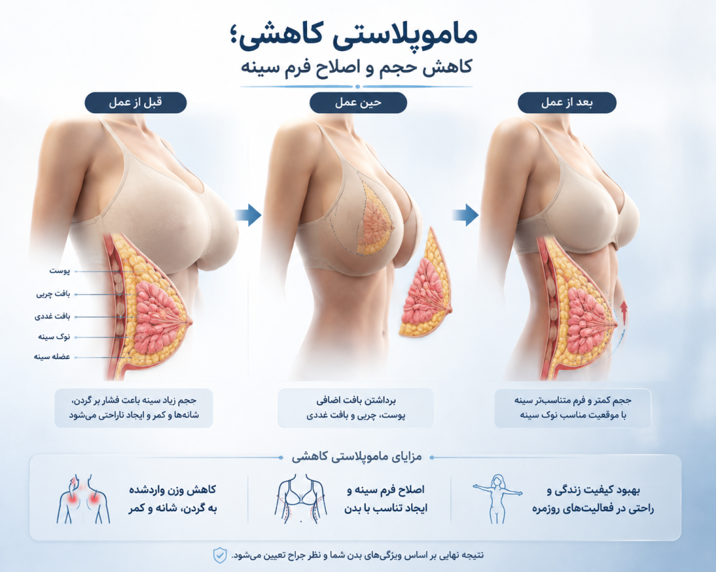 ماموپلاستی کاهشی 