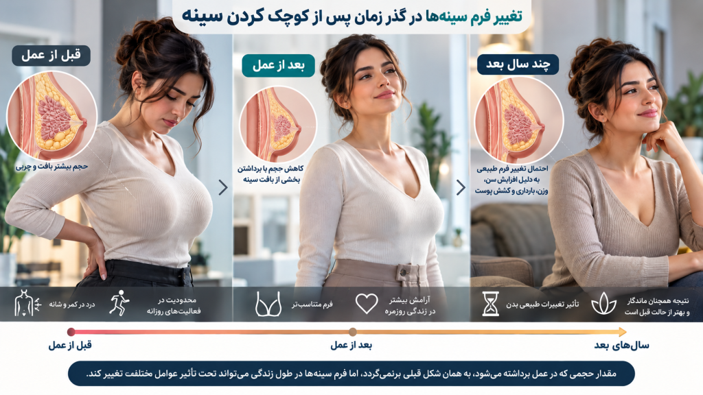 ماندگاری عمل کوچک کردن سینه